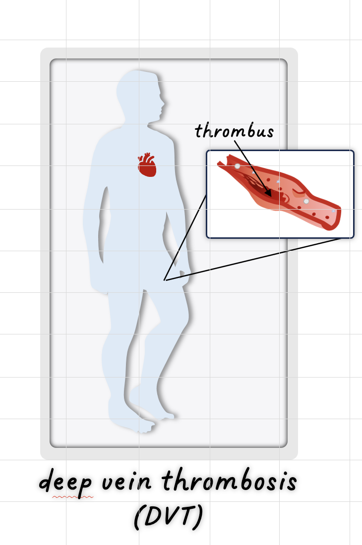Dvt Intellect Virtual Digital Twin (VDT) for enhanced clinical decision-making - Sano ...